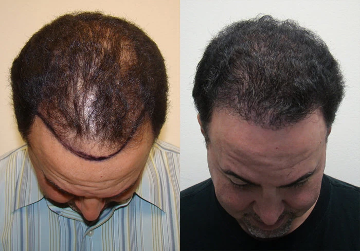 Patient p85 hair transplant before and after tilt view
