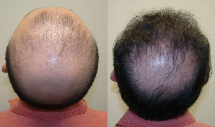 Patient p86 hair transplant before and after crown view