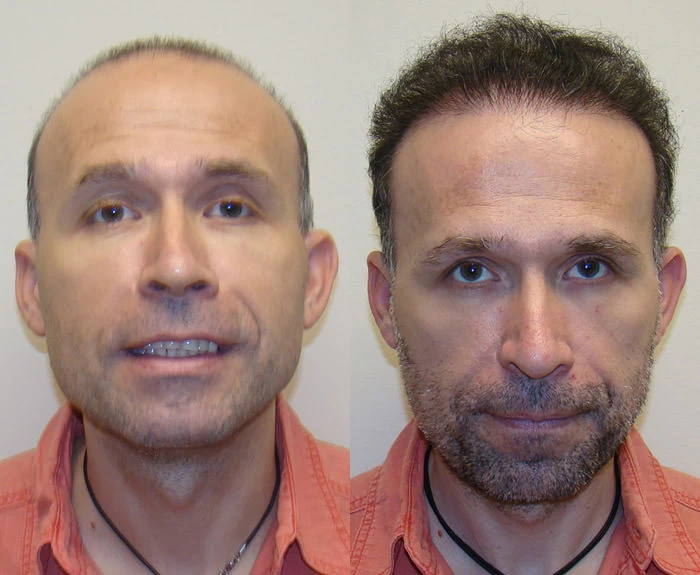 Marius Hair Transplant Before and After