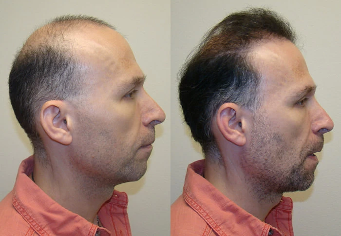 Patient p86 hair transplant before and after right view