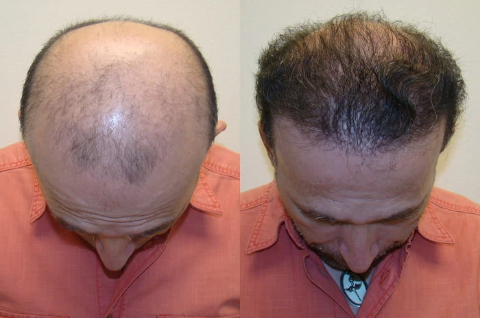 Patient p86 hair transplant before and after tilt view