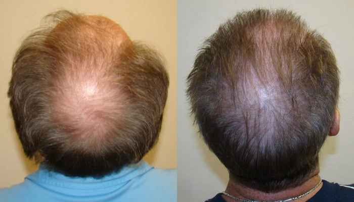 Patient p87 hair transplant before and after crown view