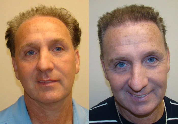 Noel Hair Transplant Before and After