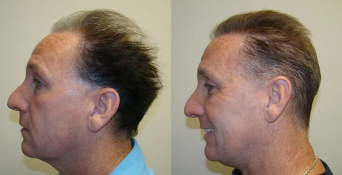 Patient p87 hair transplant before and after left view