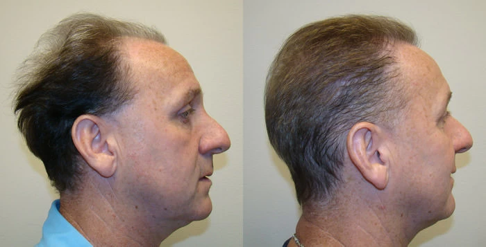 Patient p87 hair transplant before and after right view