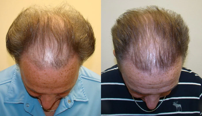 Patient p87 hair transplant before and after tilt view