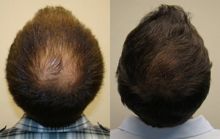 Patient p88 hair transplant before and after crown view