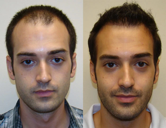 Ryan Hair Transplant Before and After