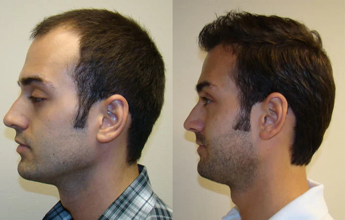 Patient p88 hair transplant before and after left view