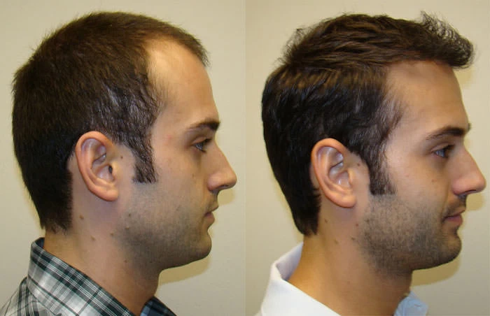 Patient p88 hair transplant before and after right view