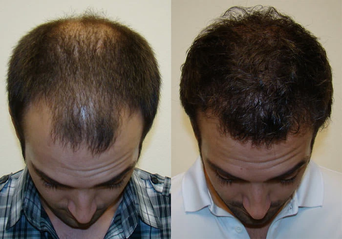 Patient p88 hair transplant before and after tilt view