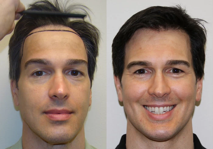 Jeff Hair Transplant Before and After