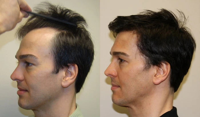 Patient p89 hair transplant before and after left view
