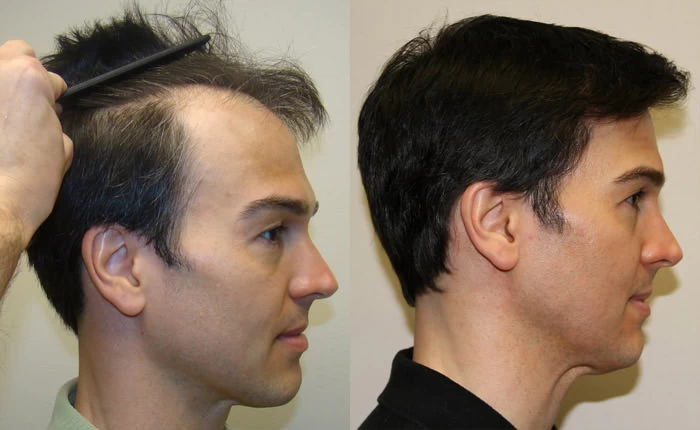 Patient p89 hair transplant before and after right view
