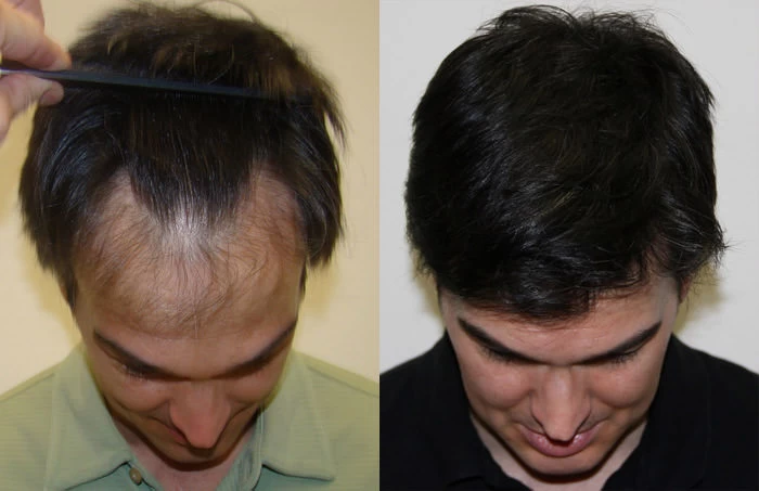 Patient p89 hair transplant before and after tilt view