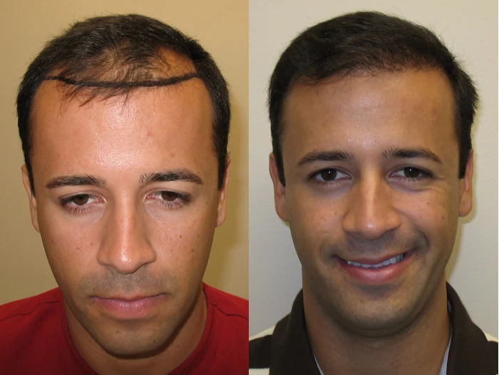 Luis Hair Transplant Before and After