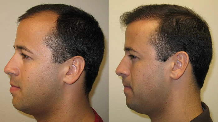 Patient p8 hair transplant before and after left view