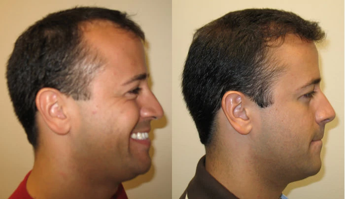 Patient p8 hair transplant before and after right view