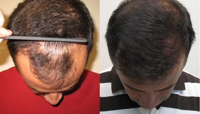 Patient p8 hair transplant before and after tilt view