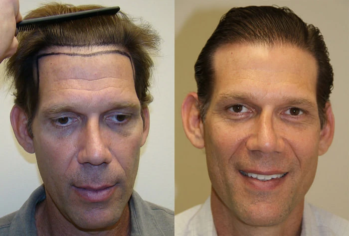 Josh Hair Transplant Before and After