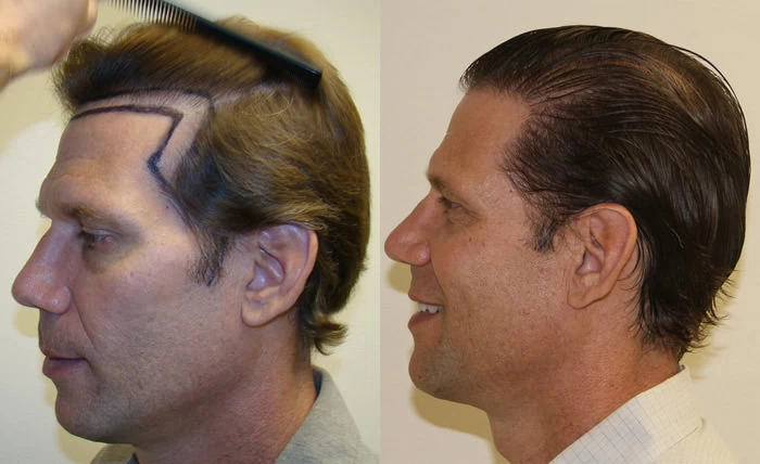 Patient p90 hair transplant before and after left view