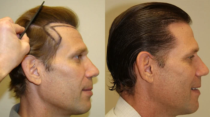 Patient p90 hair transplant before and after right view