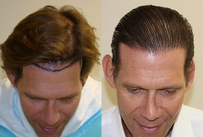 Patient p90 hair transplant before and after tilt view