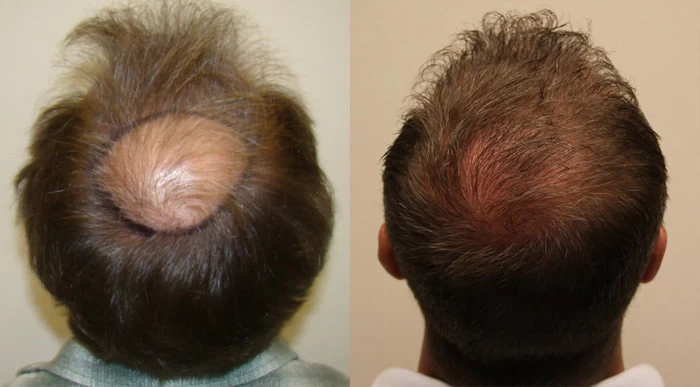 Patient p93 hair transplant before and after crown view