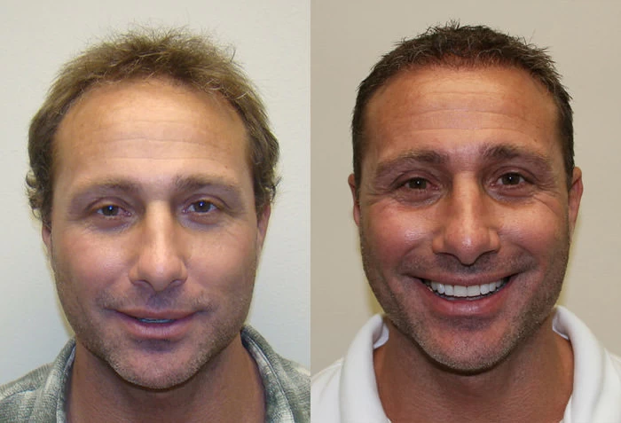 Chad Hair Transplant Before and After
