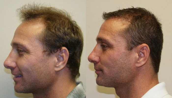 Patient p93 hair transplant before and after left view