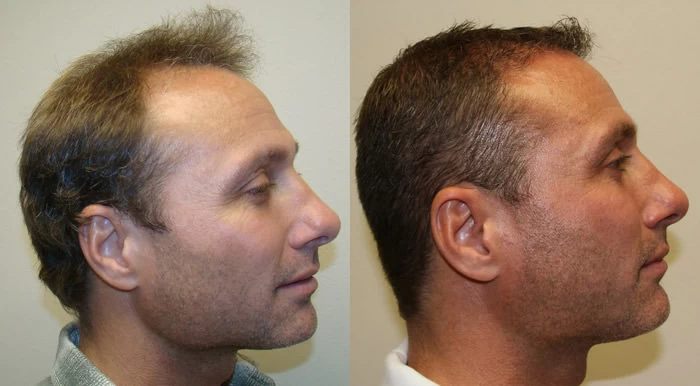 Patient p93 hair transplant before and after right view
