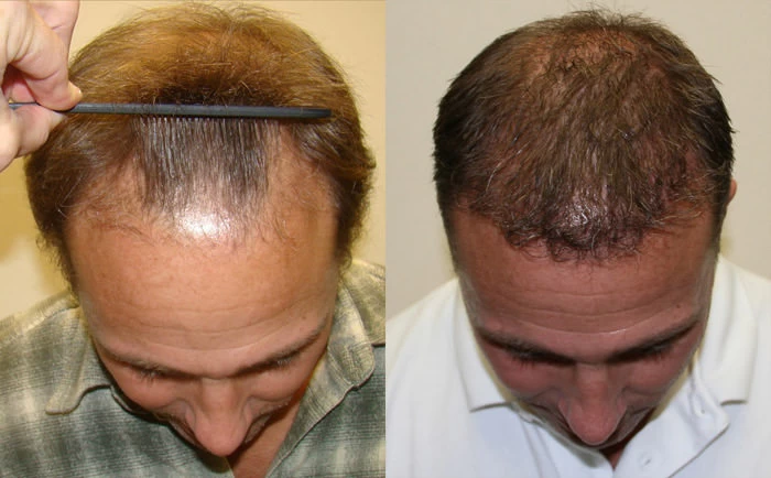 Patient p93 hair transplant before and after tilt view