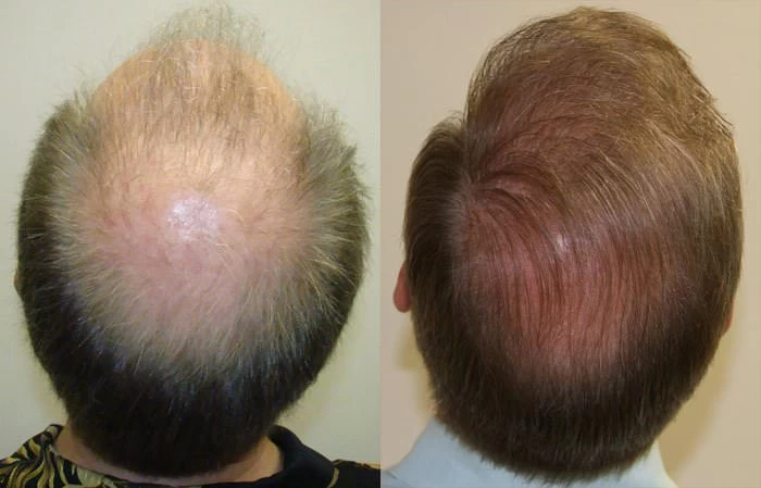 Patient p97 hair transplant before and after crown view
