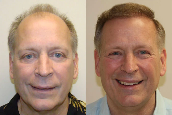 Pat Hair Transplant Before and After