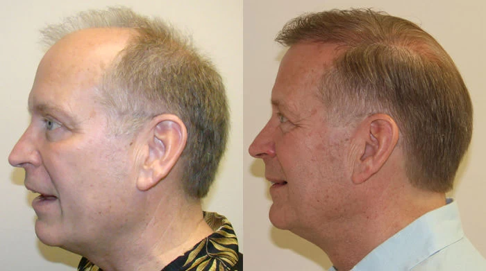 Patient p97 hair transplant before and after left view