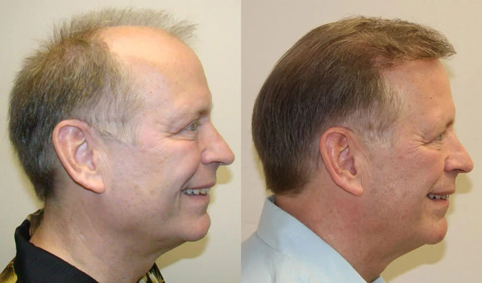 Patient p97 hair transplant before and after right view