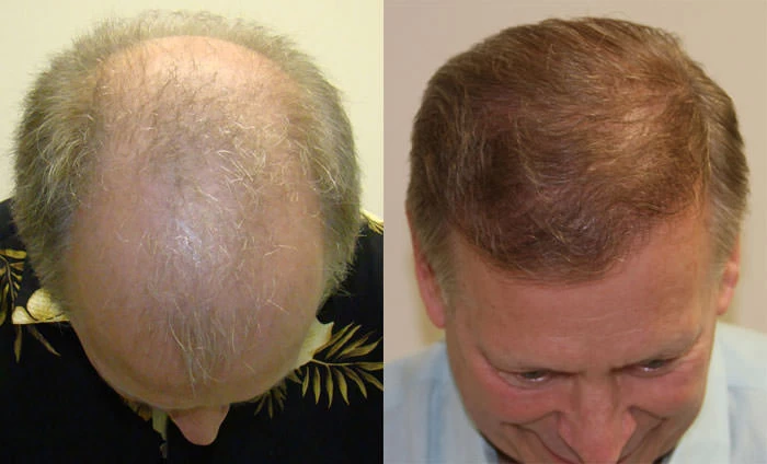 Patient p97 hair transplant before and after tilt view