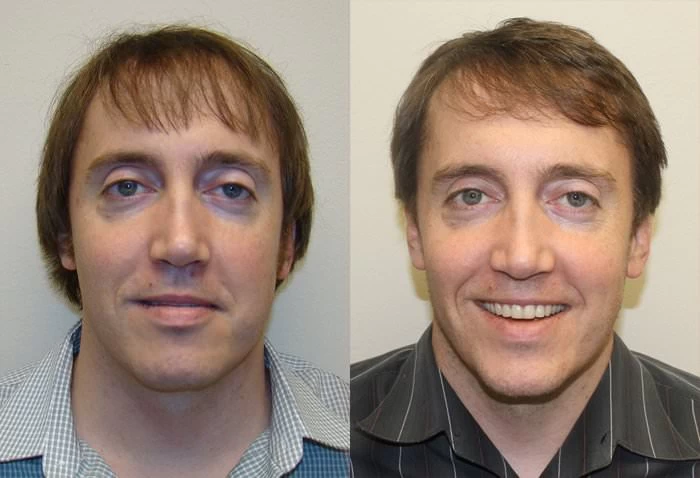 Jeff hair transplant for birth defect before and after front view