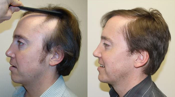 Jeff hair transplant for birth defect before and after left view
