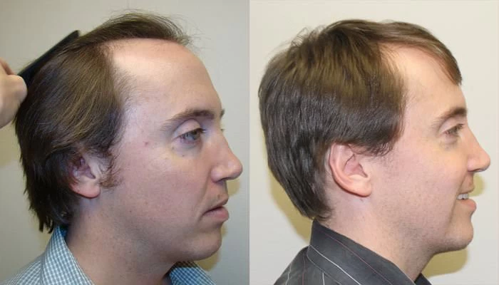 Patient p99 hair transplant before and after right view