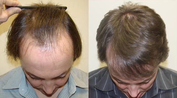 Patient p99 hair transplant before and after tilt view