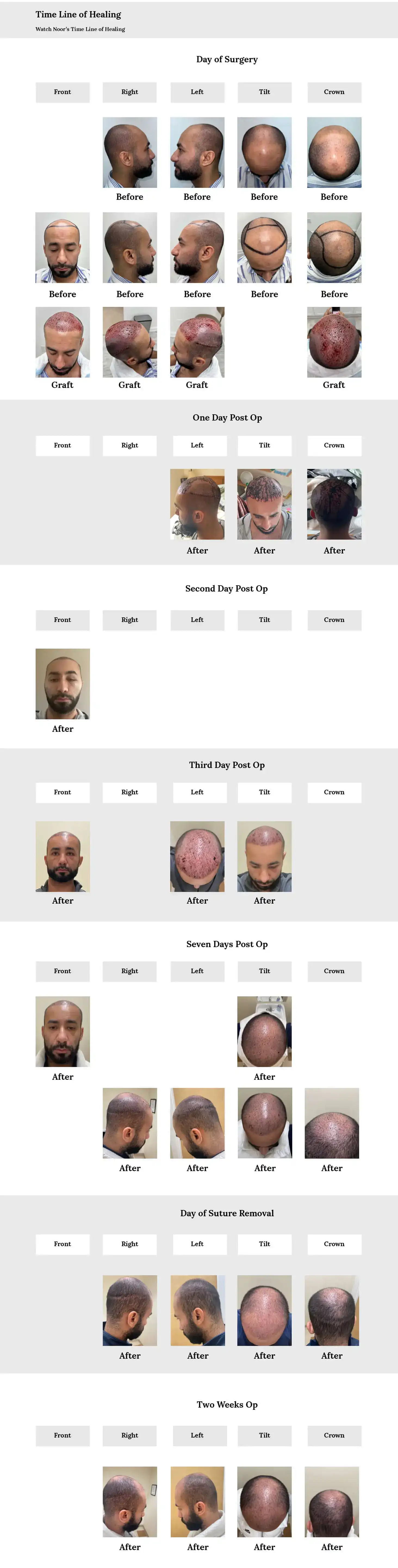 Hair transplant recovery and healing timeline